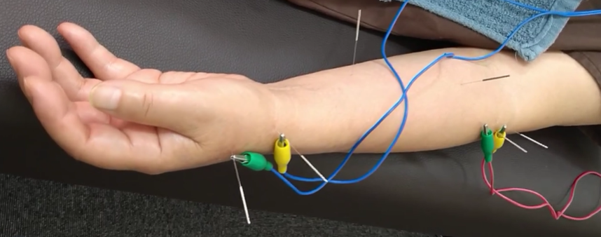 鍼通電の様子